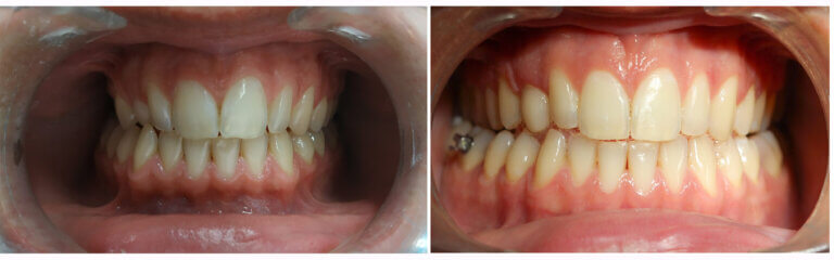 οδοντοστοιχία ασθενούς πριν και μετά τη θεραπεία