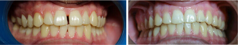 οδοντοστοιχία ασθενούς πριν και μετά τη θεραπεία